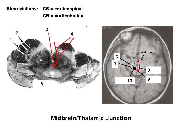 Abbreviations: CS = corticospinal CB = corticobulbar 2 CB Position of: oculomotor 3 nucleus
