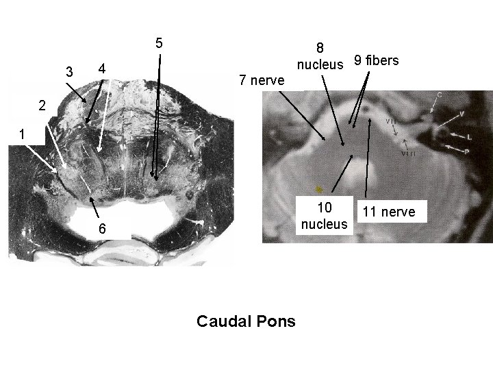 Reticular formation with reticular nuclei & descending rubrospinal fibers 5 descending cortical fibers 3
