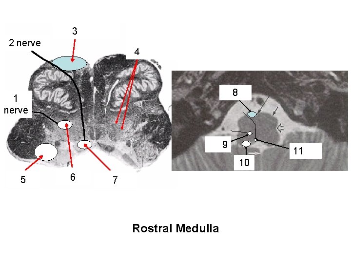 Hypoglossal 2 nerve roots Pyramidal 3 (corticospinal) tract reticular formation with reticular nuclei +