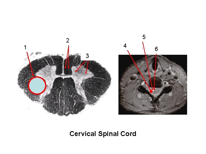 Position of: ventral horn corticospinal, vestibulospinal, with LMN & reticulospinal tracts lateral corticospinal tract