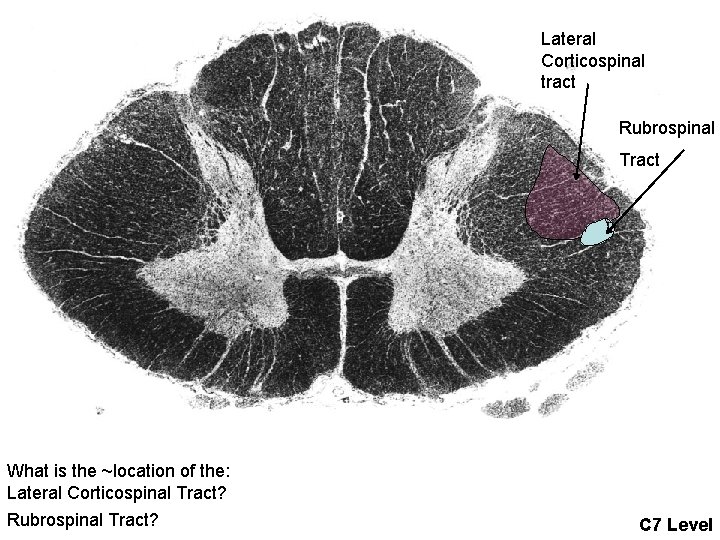 Lateral Corticospinal tract Rubrospinal Tract What is the ~location of the: Lateral Corticospinal Tract?