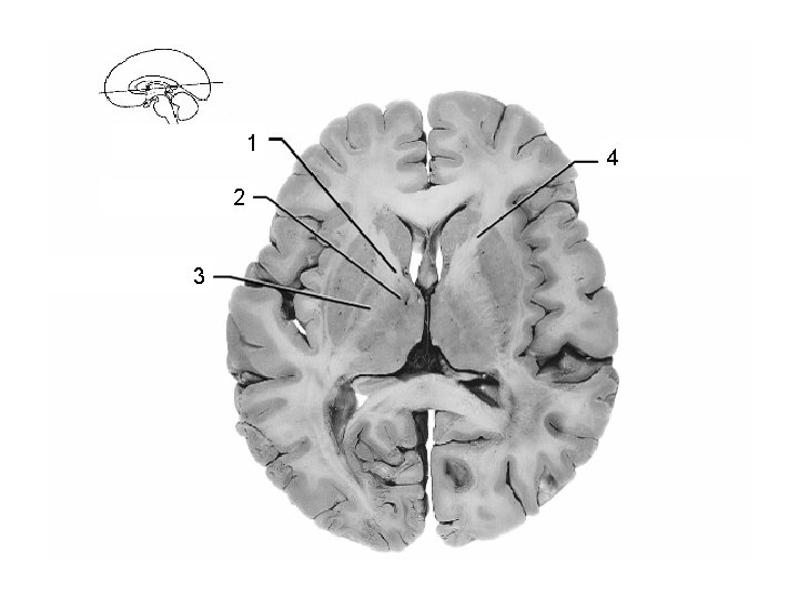 1 Thalamus 2 3 4 