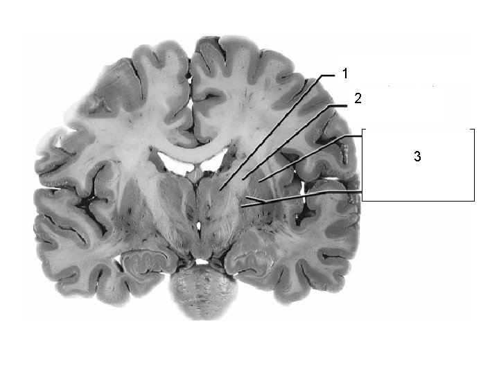1 Thalamus 2 3 Lentiform Nucleus 