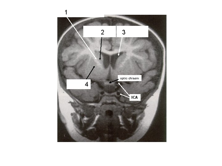 ant. limb, Int. capsule (frontal eye field fibers) 1 head of caudate nucleus 2