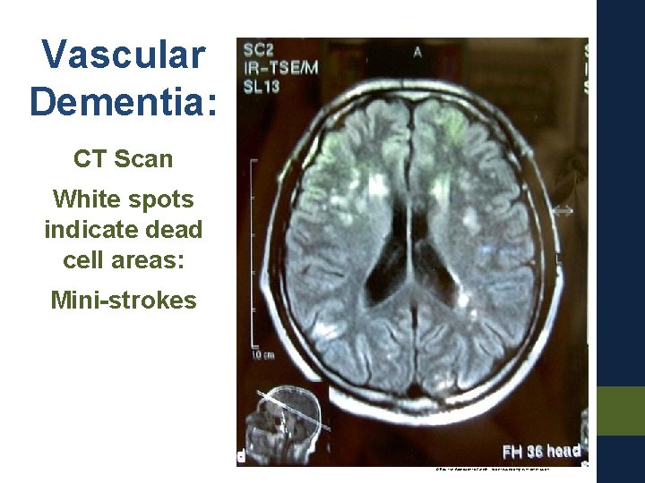 Vascular Dementia: CT Scan White spots indicate dead cell areas: Mini-strokes © Positive Approach