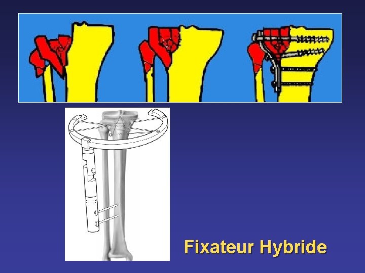 Fixateur Hybride 