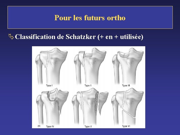 Pour les futurs ortho Ä Classification de Schatzker (+ en + utilisée) 