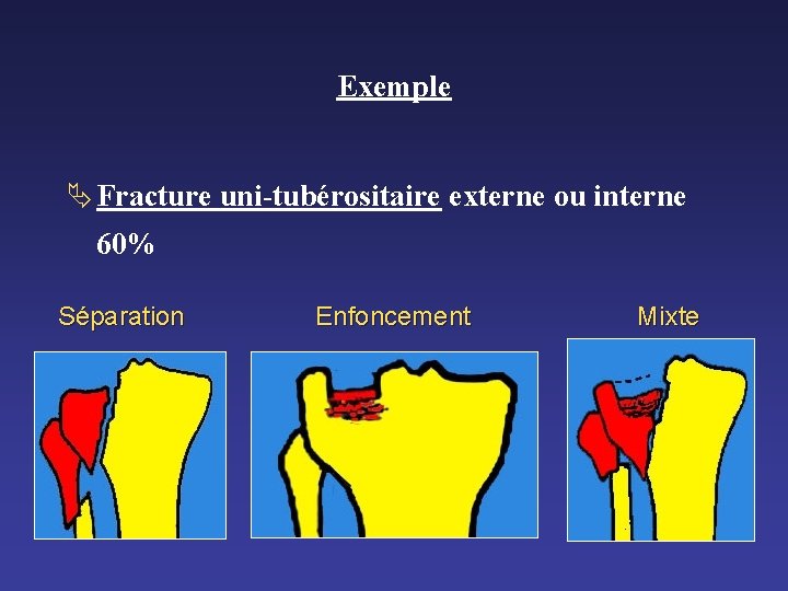 Exemple Ä Fracture uni-tubérositaire externe ou interne 60% Séparation Enfoncement Mixte 