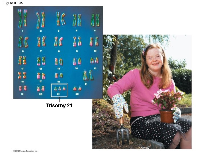 Figure 8. 19 A Trisomy 21 