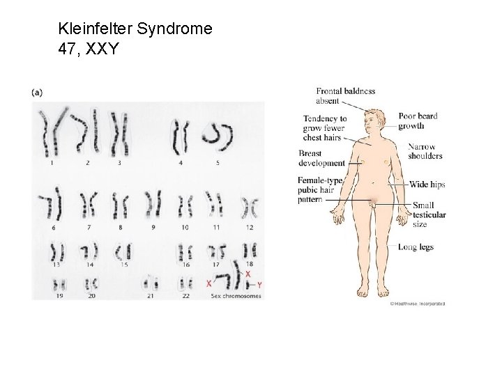 Kleinfelter Syndrome 47, XXY 