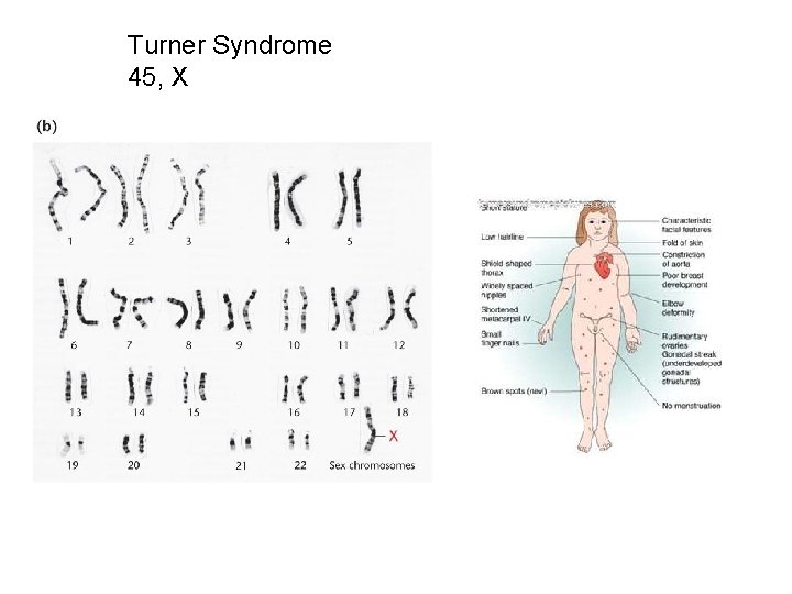 Turner Syndrome 45, X 