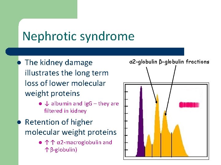 Nephrotic syndrome l The kidney damage illustrates the long term loss of lower molecular