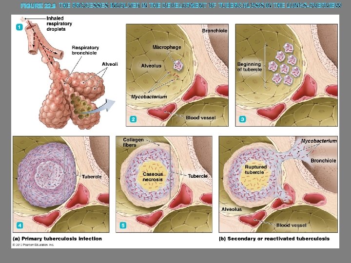 FIGURE 22. 9 THE PROCESSES INVOLVED IN THE DEVELOPMENT OF TUBERCULOSIS IN THE LUNGS-OVERVIEW