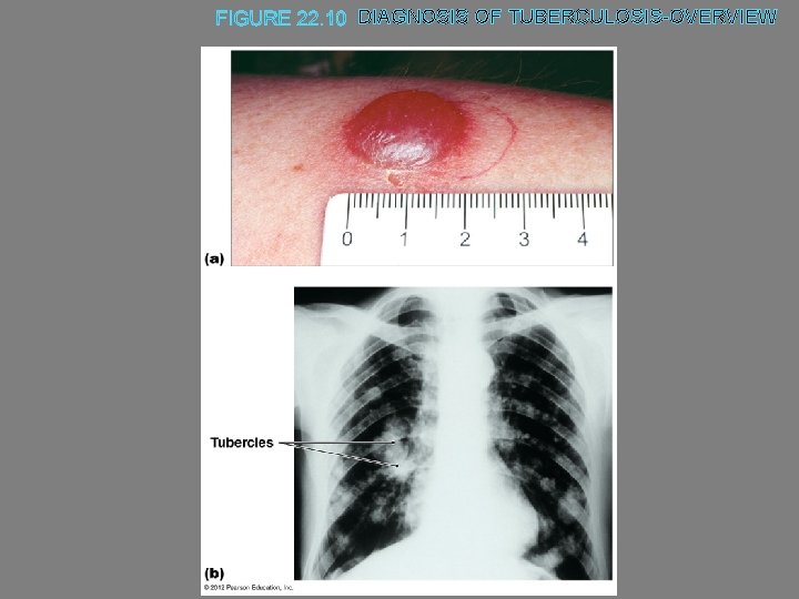 DIAGNOSIS OF TUBERCULOSIS-OVERVIEW 