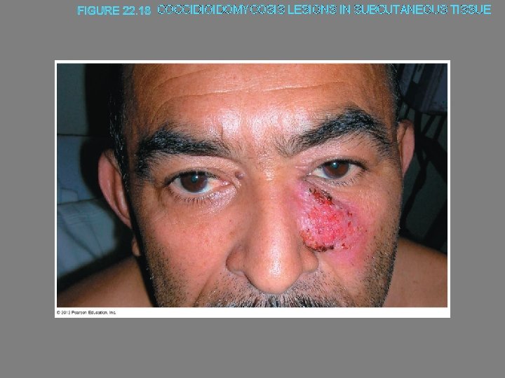 COCCIDIOIDOMYCOSIS LESIONS IN SUBCUTANEOUS TISSUE 