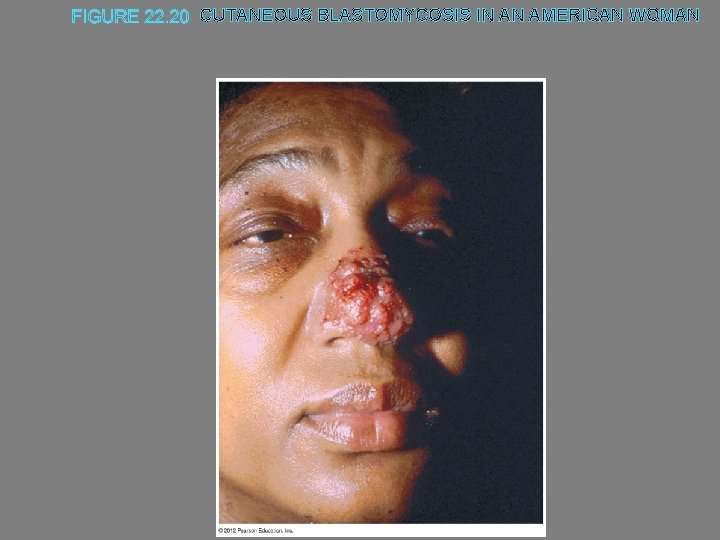 CUTANEOUS BLASTOMYCOSIS IN AN AMERICAN WOMAN 