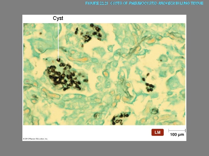 FIGURE 22. 21 CYSTS OF PNEUMOCYSTIS JIROVECII IN LUNG TISSUE Cyst 