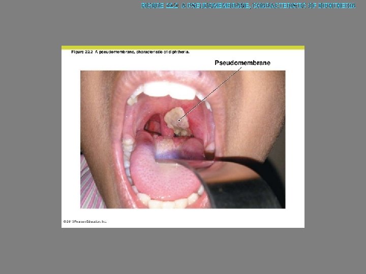 FIGURE 22. 2 A PSEUDOMEMBRANE, CHARACTERISTIC OF DIPHTHERIA 