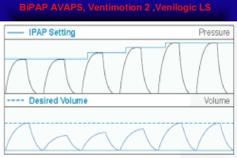 Bi. PAP AVAPS, Ventimotion 2 , Venilogic LS 