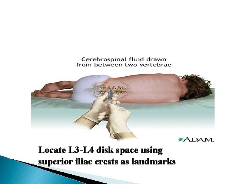 Locate L 3 -L 4 disk space using superior iliac crests as landmarks 