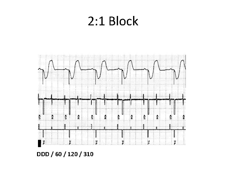 2: 1 Block DDD / 60 / 120 / 310 