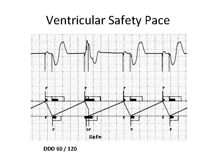 Ventricular Safety Pace DDD 60 / 120 