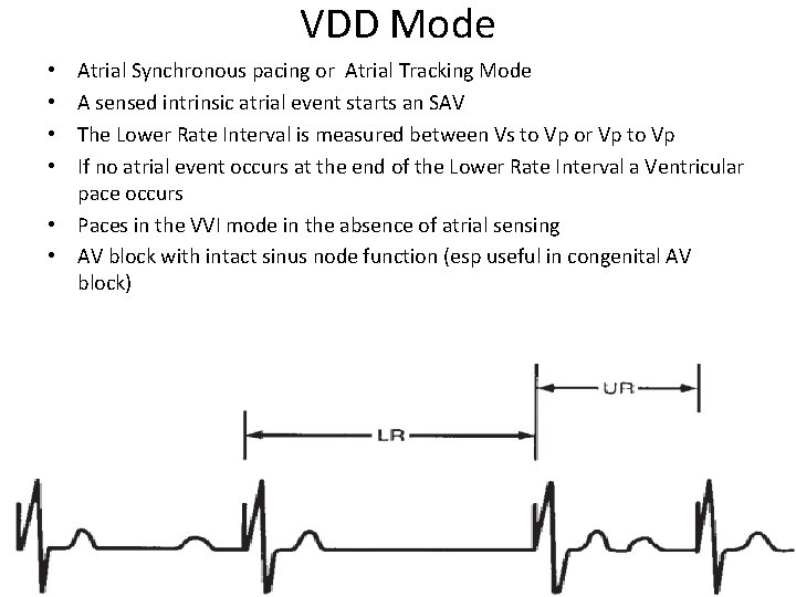 VDD Mode Atrial Synchronous pacing or Atrial Tracking Mode A sensed intrinsic atrial event