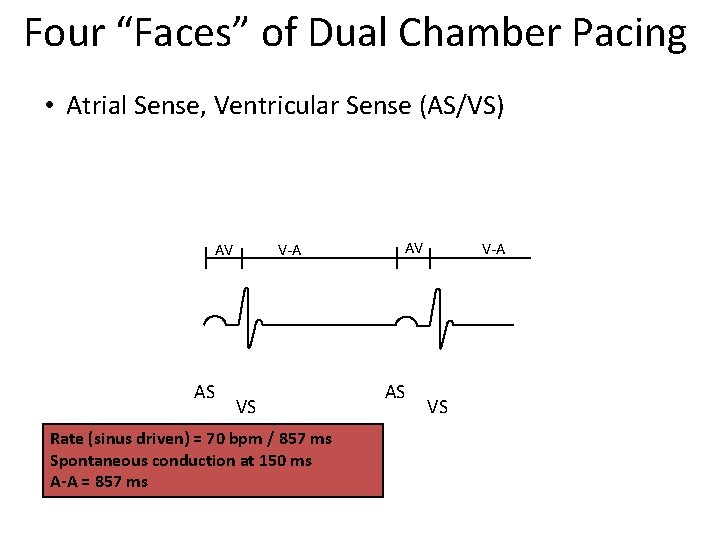 Four “Faces” of Dual Chamber Pacing • Atrial Sense, Ventricular Sense (AS/VS) AV AS