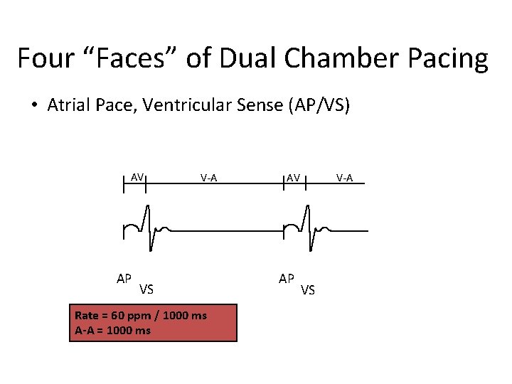 Four “Faces” of Dual Chamber Pacing • Atrial Pace, Ventricular Sense (AP/VS) AV AP
