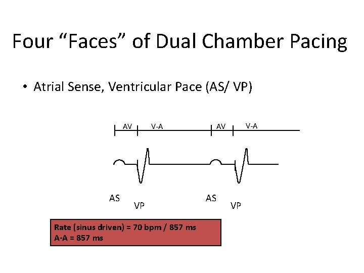 Four “Faces” of Dual Chamber Pacing • Atrial Sense, Ventricular Pace (AS/ VP) AV