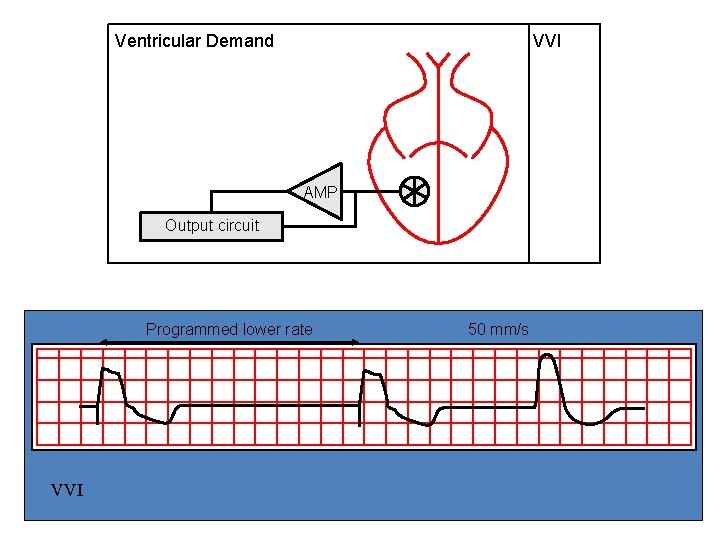 Ventricular Demand VVI AMP Output circuit Programmed lower rate VVI 50 mm/s 