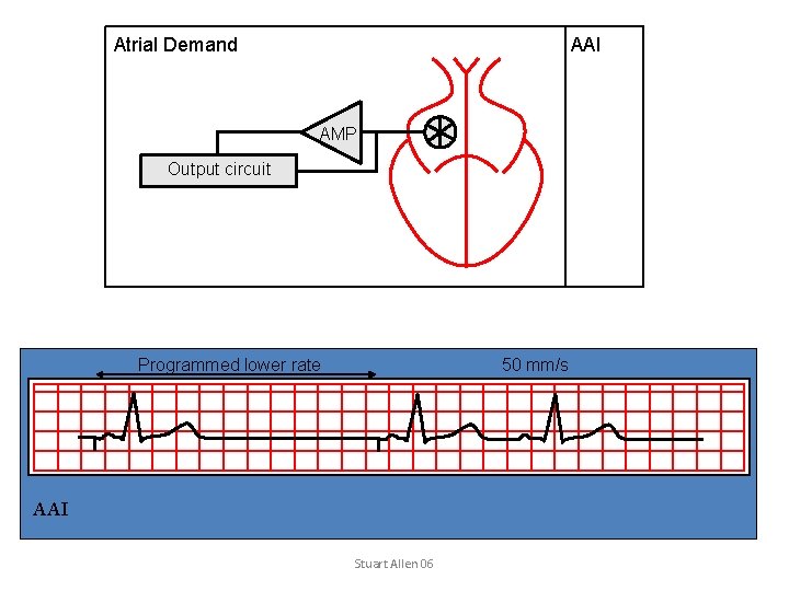 Atrial Demand AAI AMP Output circuit Programmed lower rate 50 mm/s AAI Stuart Allen