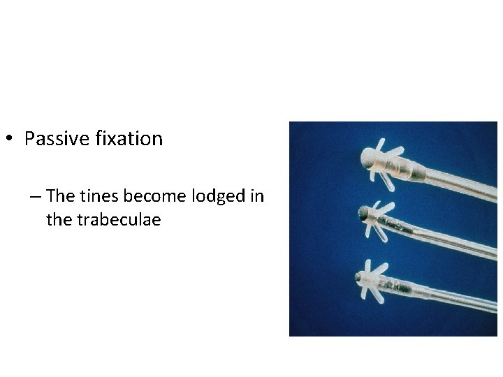  • Passive fixation – The tines become lodged in the trabeculae 