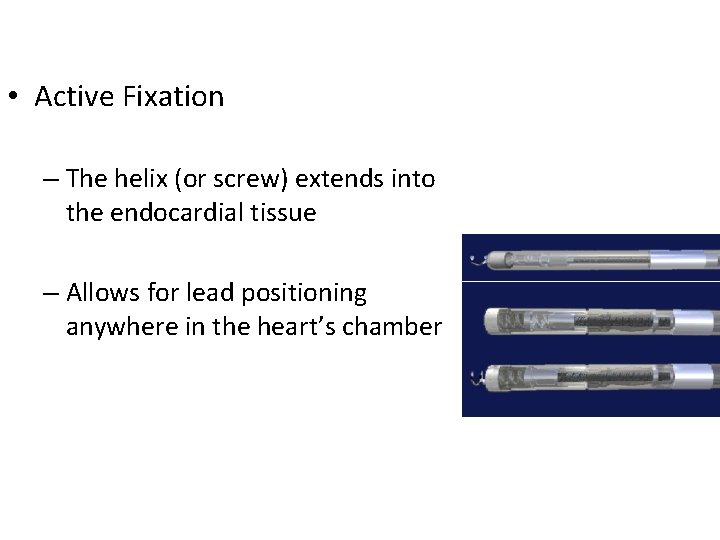  • Active Fixation – The helix (or screw) extends into the endocardial tissue