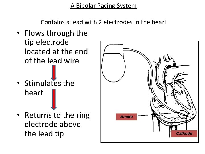 A Bipolar Pacing System Contains a lead with 2 electrodes in the heart •
