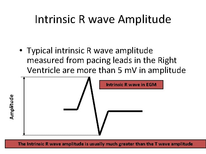 Intrinsic R wave Amplitude • Typical intrinsic R wave amplitude measured from pacing leads