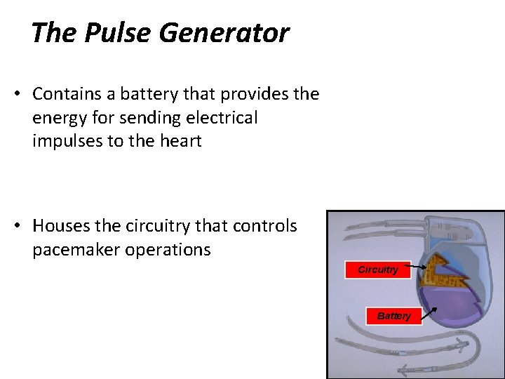 The Pulse Generator • Contains a battery that provides the energy for sending electrical