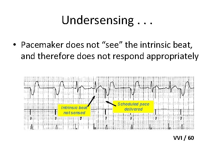 Undersensing. . . • Pacemaker does not “see” the intrinsic beat, and therefore does