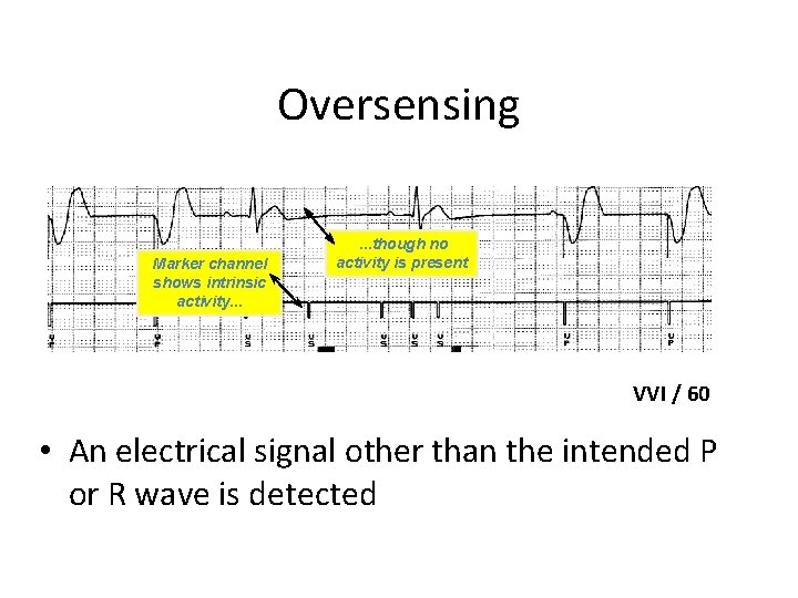 Oversensing Marker channel shows intrinsic activity. . . though no activity is present VVI