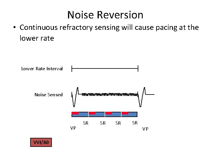 Noise Reversion • Continuous refractory sensing will cause pacing at the lower rate Lower