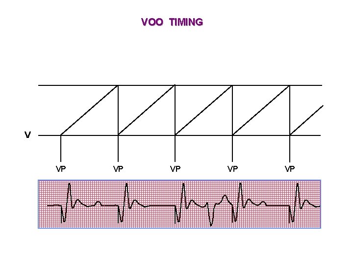 VOO TIMING V VP VP VP 