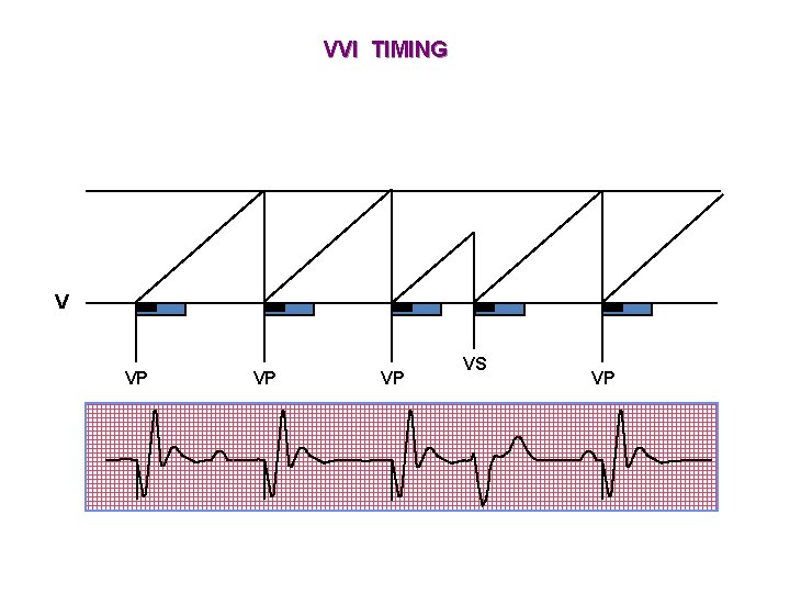 VVI TIMING V VP VP VP VS VP 