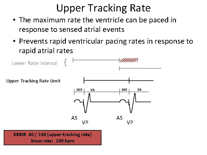 Upper Tracking Rate • The maximum rate the ventricle can be paced in response