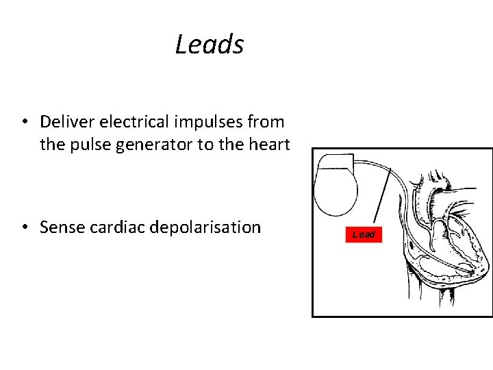 Leads • Deliver electrical impulses from the pulse generator to the heart • Sense