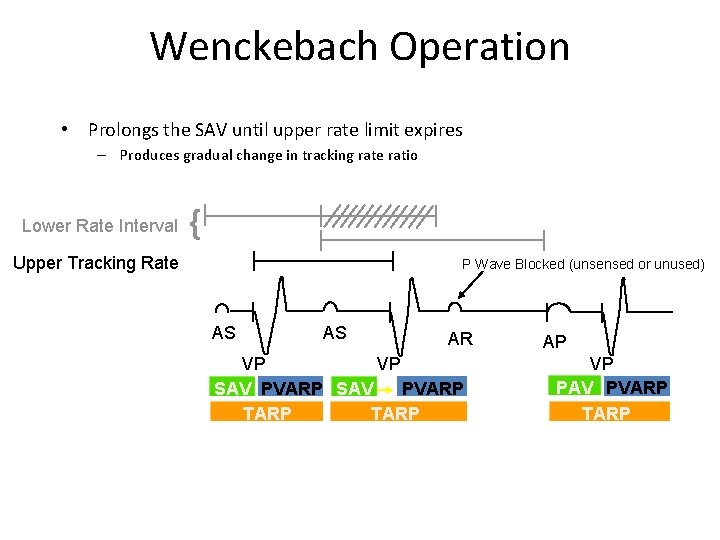 Wenckebach Operation • Prolongs the SAV until upper rate limit expires – Produces gradual
