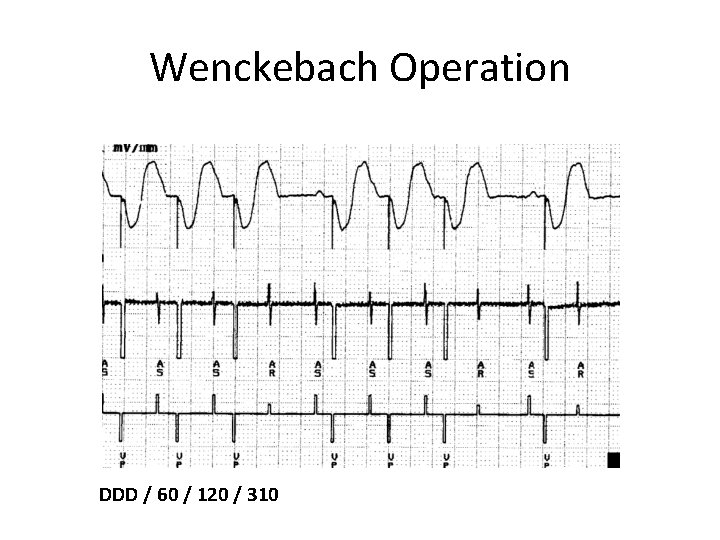 Wenckebach Operation DDD / 60 / 120 / 310 
