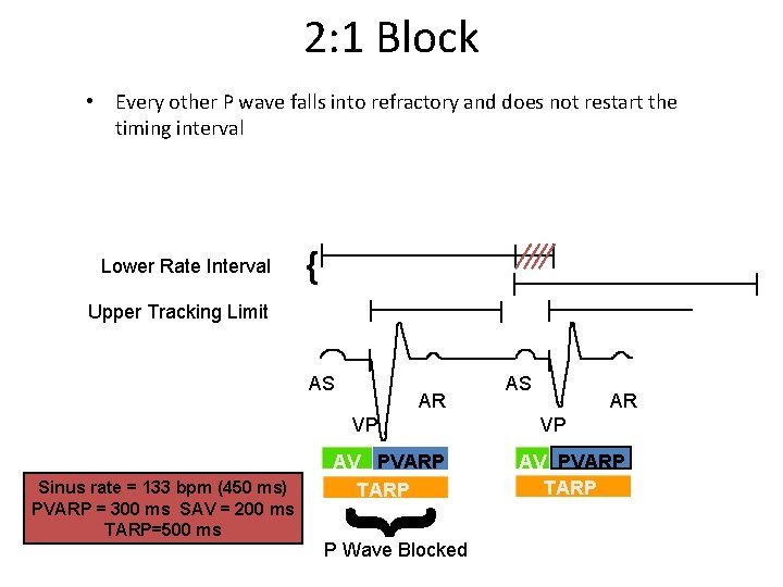 2: 1 Block • Every other P wave falls into refractory and does not