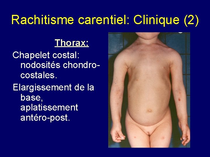 Rachitisme carentiel: Clinique (2) Thorax: Chapelet costal: nodosités chondrocostales. Elargissement de la base, aplatissement