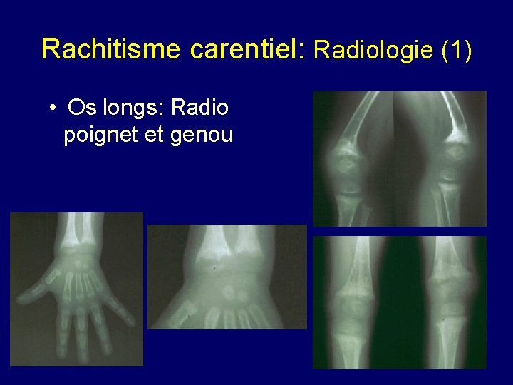 Rachitisme carentiel: Radiologie (1) • Os longs: Radio poignet et genou 