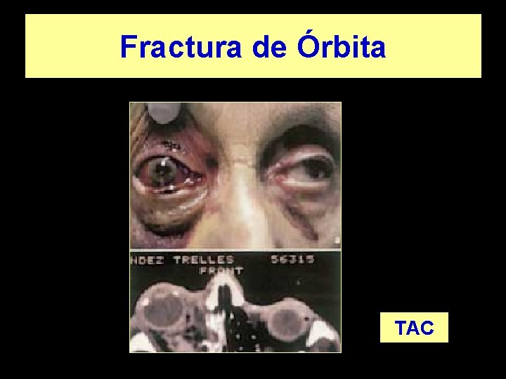 Fractura de Órbita TAC 